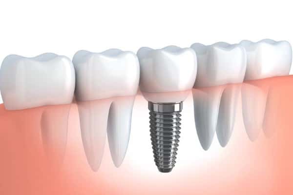 Implants.