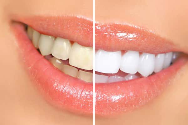 Teeth Whitening.