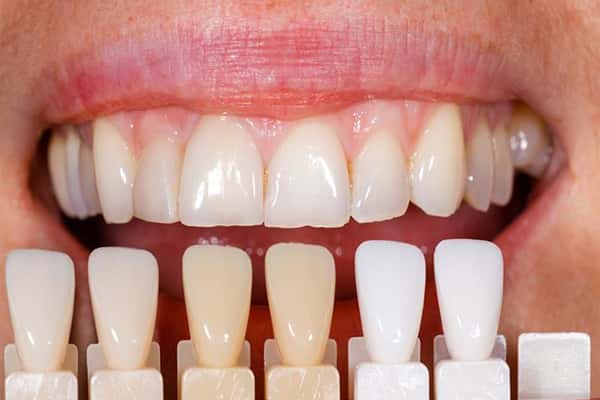 Dental veneers in Canton MA.