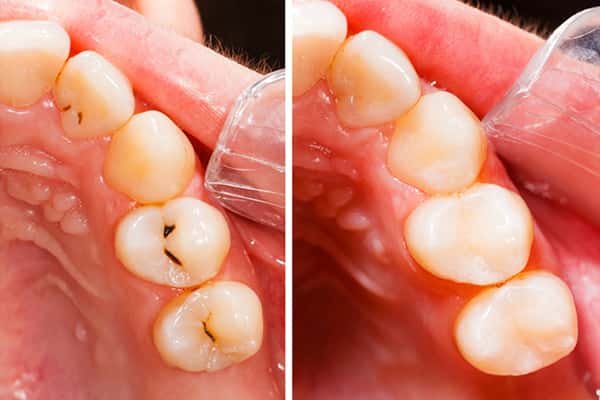 Fillings in Canton MA.