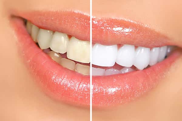 Teeth Whitening in Canton MA.