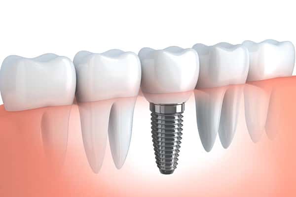 Dental Implants in Canton MA.